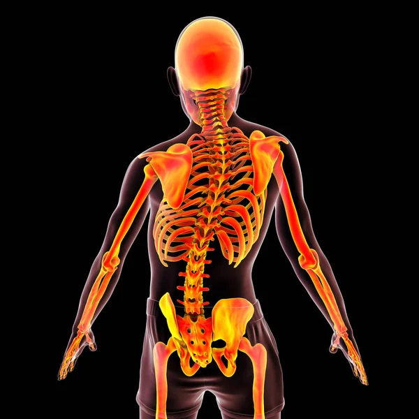 Skolioza Ilustracja Ludzkie Ciało Zakrzywionym Kręgosłupem Nierównymi Ramionami Biodrami Anatomia — Zdjęcie stockowe