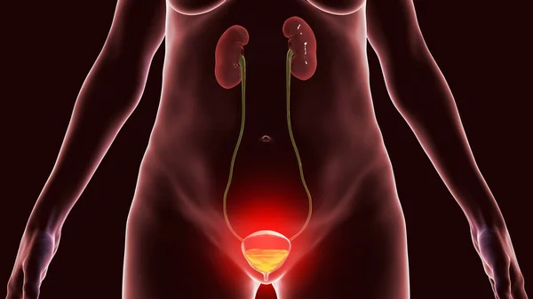 Cystitis Infection Urinary Bladder Conceptual Illustration Showing Inflammation Bladder — Stock Photo, Image
