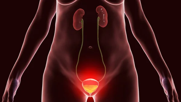 Cystite Infection Vessie Illustration Conceptuelle Montrant Une Inflammation Vessie — Photo