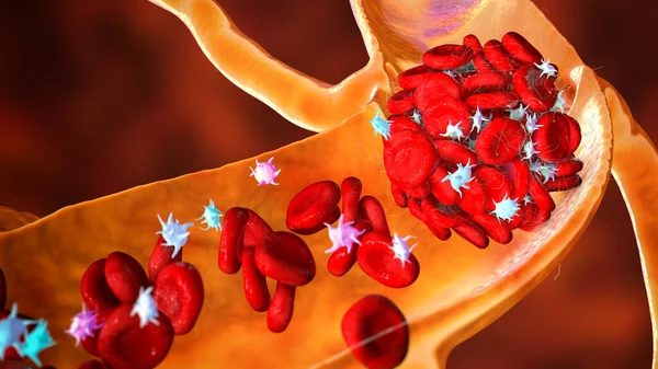 Coágulo Sanguíneo Feito Glóbulos Vermelhos Plaquetas Fibrina Proteínas Trombo Ilustração — Fotografia de Stock