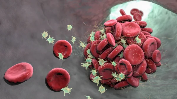 Coágulo Sangre Hecho Glóbulos Rojos Plaquetas Hebras Proteína Fibrina Trombo — Foto de Stock