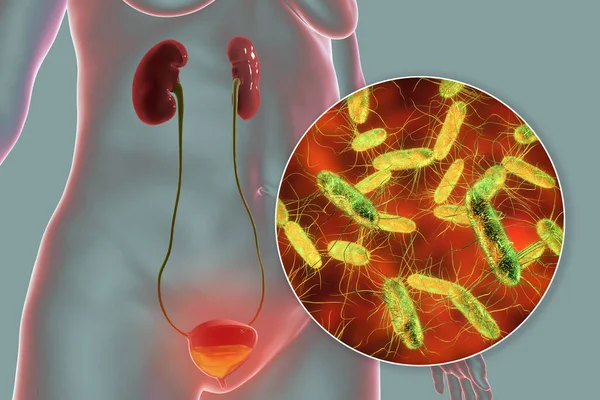 Cystit Bakteriell Infektion Urinblåsan Konceptuell Illustration Som Visar Bakterier Urinen — Stockfoto
