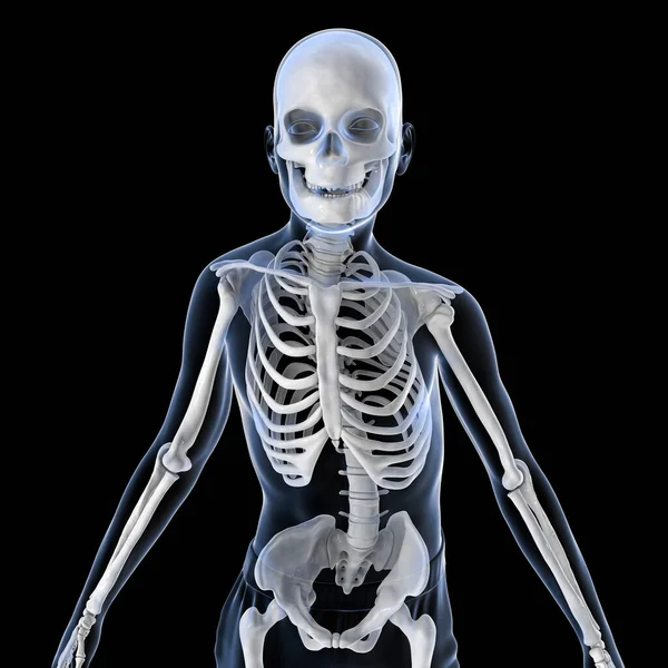 Scoliosis, 3D illustration. A human body with curved spine, uneven shoulders and hips. Spine curve anatomy. A child with scoliosis and highlighted skeleton, front view