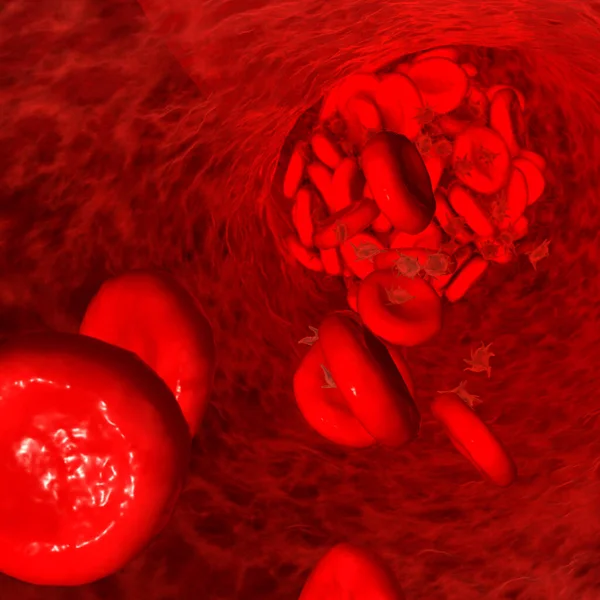 Coágulo Sangre Hecho Glóbulos Rojos Plaquetas Hebras Proteína Fibrina Trombo — Foto de Stock