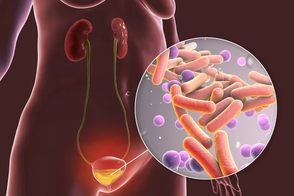 Cistitis Infección Bacteriana Vejiga Urinaria Ilustración Conceptual Que Muestra Bacterias — Foto de Stock