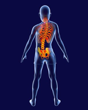 Skolyoz, 3 boyutlu illüstrasyon. Omurgası kıvrımlı, omuzları ve kalçaları düzgün olmayan bir insan vücudu. Omurga eğrisi anatomisi. Skolyoz ve altı çizili iskeleti olan bir çocuk.