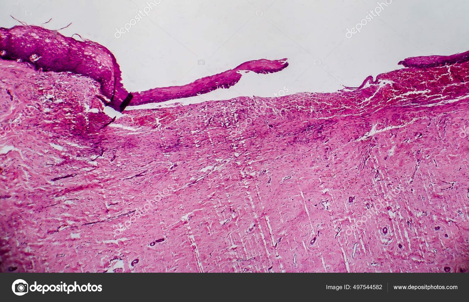 Cervikal Erosion Også Kendt Som Eversion Ektropion Lys Mikrograf Foto  Stockillustration af ©katerynakon #497544582, image size:1600x1030