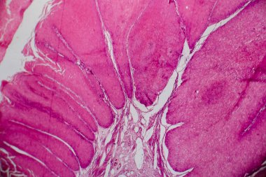 Condyloma acuminatum, genital siğil olarak da bilinir. Işık mikrografı, mikroskop altında fotoğraf.