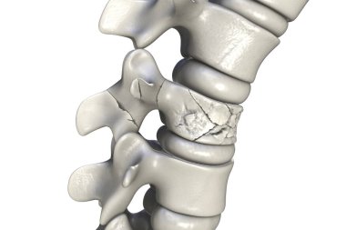 Omurga kırığı, travmatik omur hasarı, üç boyutlu illüstrasyon. Omurga kırığı.