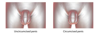 Circumcised and uncircumcised penis, anatomical 3D illustration