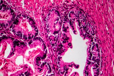 Yumurtalık kanseri, ışık mikrografı, mikroskop altında fotoğraf. Fotoğrafta, kadın yumurtalığında kanserli bir tümör olduğu görülüyor. Seçici odak