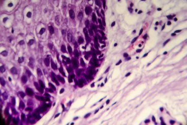 Rahim ağzı kanseri. Servikal biyopsinin hafif mikrografisi. Mikroskop altında fotoğraf. Seçici odak