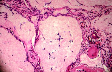 Yumurtalık kisti, hafif mikrograf, mikroskop altında fotoğraf. Fotoğrafta dişi yumurtalıktaki kistin bir parçası görünüyor. Seçici odak