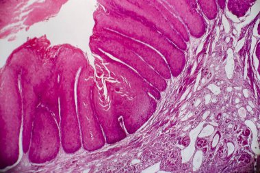 Condyloma acuminatum, genital siğil olarak da bilinir. Işık mikrografı, mikroskop altında fotoğraf.