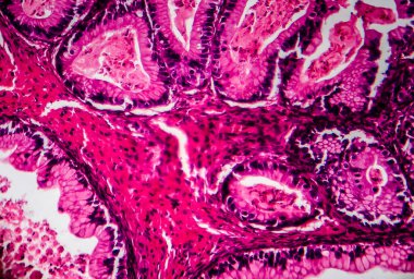 Yumurtalık kanseri, ışık mikrografı, mikroskop altında fotoğraf. Fotoğrafta, kadın yumurtalığında kanserli bir tümör olduğu görülüyor. Seçici odak