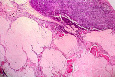 Yumurtalık kisti, hafif mikrograf, mikroskop altında fotoğraf. Fotoğrafta dişi yumurtalıktaki kistin bir parçası görünüyor. Seçici odak