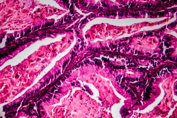 Cáncer Ovario Micrografía Ligera Foto Bajo Microscopio Fotografía Muestra Fragmento — Foto de Stock