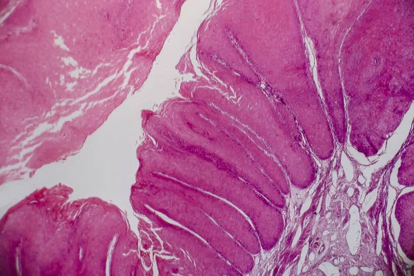 Condiloma Acuminatum También Conocido Como Verrugas Genitales Micrografía Ligera Foto — Foto de Stock