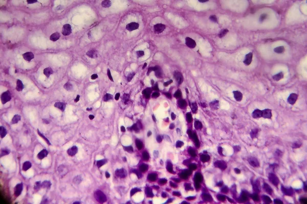 Gebärmutterhalskrebs Leichte Mikrographie Der Gebärmutterhalsbiopsie Foto Unter Dem Mikroskop Selektiver — Stockfoto