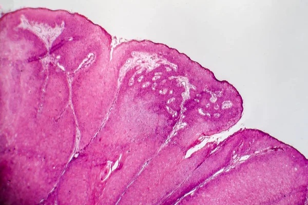 Condyloma Acuminatum Genital Siğil Olarak Bilinir Işık Mikrografı Mikroskop Altında — Stok fotoğraf