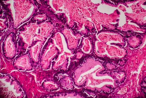 Cancro Ovarico Microscopio Luce Foto Microscopio Fotografia Mostra Frammento Tumore — Foto Stock