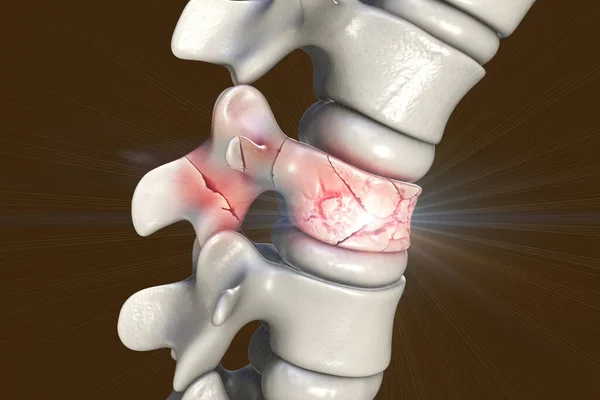 Fratura Coluna Vertebral Lesão Vertebral Traumática Ilustração Fratura Por Compressão — Fotografia de Stock