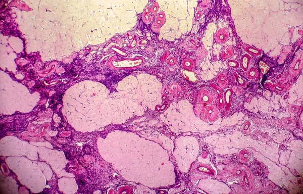 Quiste Ovárico Micrografía Ligera Foto Bajo Microscopio Fotografía Muestra Fragmento —  Fotos de Stock