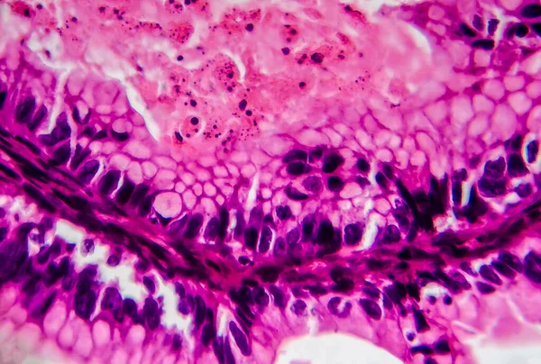 卵巣がん 軽いマイクログラフ 顕微鏡下の写真 写真は卵巣の癌腫瘍の断片を示している 選択的焦点 — ストック写真