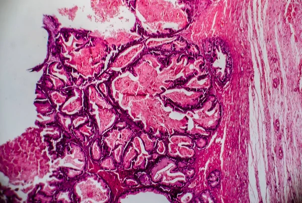 Ovarian cancer, light micrograph, photo under microscope. Photograph shows a fragment of a cancerous tumor in the female ovary. Selective focus