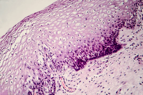 子宫颈癌 宫颈活检平片 照片在显微镜下 有选择的重点 — 图库照片