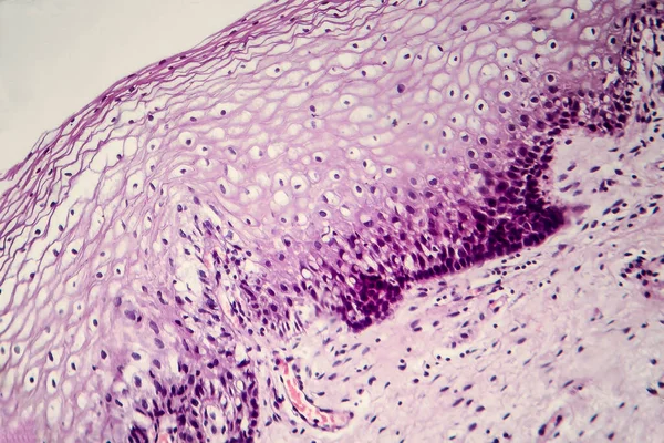 Gebärmutterhalskrebs Leichte Mikrographie Der Gebärmutterhalsbiopsie Foto Unter Dem Mikroskop Selektiver — Stockfoto