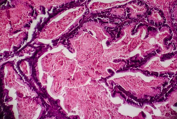 Eierstockkrebs Lichtmikroskopie Foto Unter Dem Mikroskop Das Foto Zeigt Ein — Stockfoto