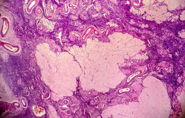 Quiste Ovárico Micrografía Ligera Foto Bajo Microscopio Fotografía Muestra Fragmento —  Fotos de Stock