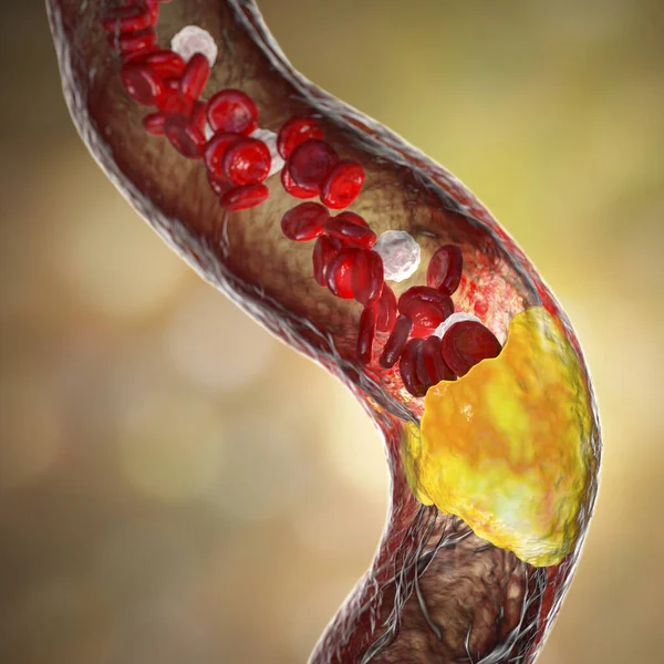 动脉粥样硬化 动脉内的动脉粥样斑块导致血管狭窄 3D插图 冠心病 外周血管疾病 — 图库照片