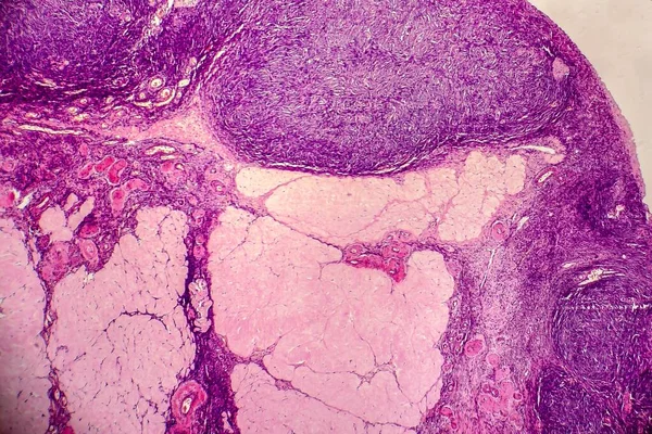 Ovarian Cyst Light Micrograph Photo Microscope Photograph Shows Fragment Cyst — Stock Photo, Image