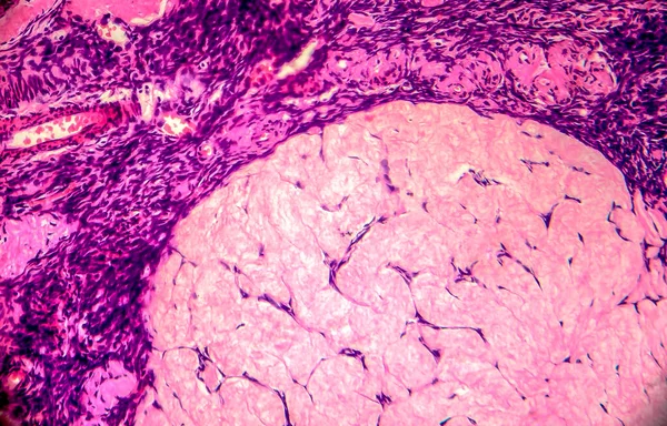 Ovariumcyste Lichtmicrograaf Foto Onder Microscoop Foto Toont Een Fragment Van — Stockfoto