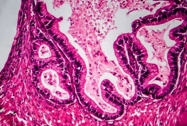 卵巢癌 显微镜下照片 图上显示了女性卵巢癌的一个片段 有选择的重点 — 图库照片