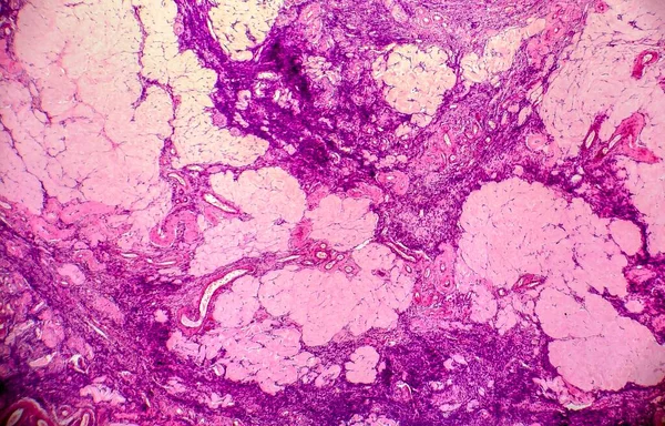 Ovariální Cysta Světelný Mikrograf Fotografie Pod Mikroskopem Fotografie Ukazuje Fragment — Stock fotografie