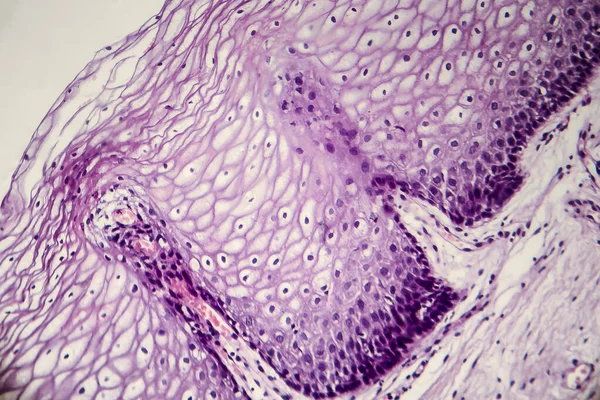 Cáncer Cuello Uterino Micrografía Ligera Biopsia Cervical Foto Bajo Microscopio — Foto de Stock