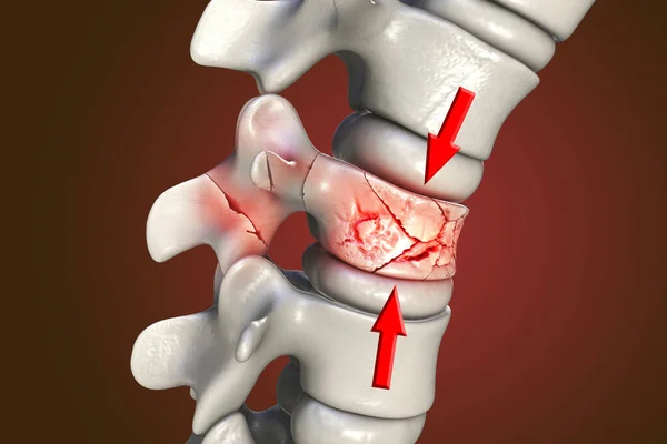 Spinal Fracture Traumatic Vertebral Injury Illustration Compression Fracture Spine — Stock Photo, Image