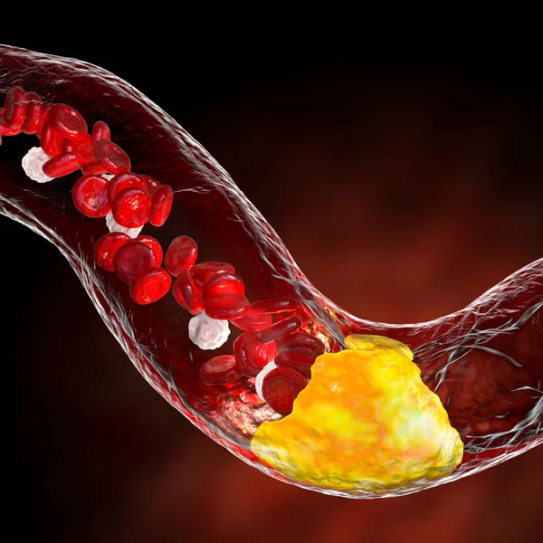 动脉粥样硬化 动脉内的动脉粥样斑块导致血管狭窄 3D插图 冠心病 外周血管疾病 — 图库照片