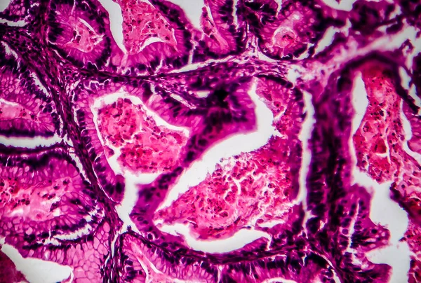 Ovarian cancer, light micrograph, photo under microscope. Photograph shows a fragment of a cancerous tumor in the female ovary. Selective focus