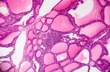 Toksik difüzyon guatrı ya da Graves hastalığı tiroidi etkileyen otoimmün bir hastalık. Işık mikrografı hiperplastik tiroid folikülleri gösteriyor.