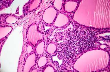 Toksik difüzyon guatrı ya da Graves hastalığı tiroidi etkileyen otoimmün bir hastalık. Işık mikrografı hiperplastik tiroid folikülleri gösteriyor.