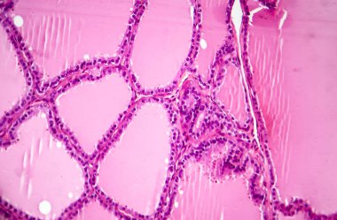 Toksik difüzyon guatrı ya da Graves hastalığı tiroidi etkileyen otoimmün bir hastalık. Işık mikrografı hiperplastik tiroid folikülleri, papiller kıvrımları gösteriyor.