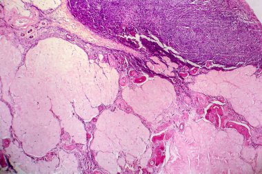 Yumurtalık kisti, hafif mikrograf, mikroskop altında fotoğraf. Fotoğrafta dişi yumurtalıktaki kistin bir parçası görünüyor. Seçici odak