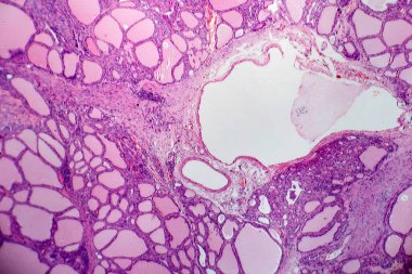 Endemik guatr, hafif mikrograf, diyet iyot yetersizliğinden dolayı tiroit bezinin anormal genişlemesi. Fotomikrograf değişen boyutlarda foliküller gösteriyor, bol miktarda kolloid, lenfositik sızma