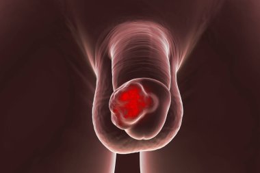 Penile cancer, 3D illustration showing malignant tumor on the human penis clipart