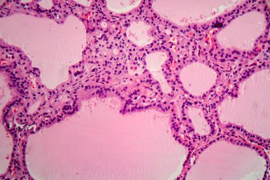 Endemik guatr, hafif mikrograf, diyet iyot yetersizliğinden dolayı tiroit bezinin anormal genişlemesi. Fotomikrograf değişen boyutlarda foliküller gösteriyor, bol miktarda kolloid, lenfositik sızma