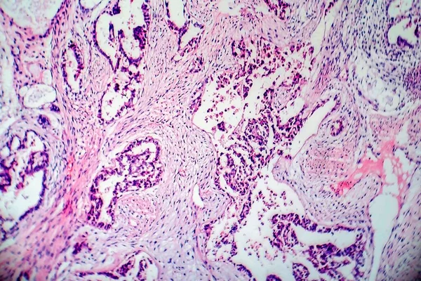 Light Micrograph Teratoma Tumor Made Several Different Types Tissue Hair — Zdjęcie stockowe